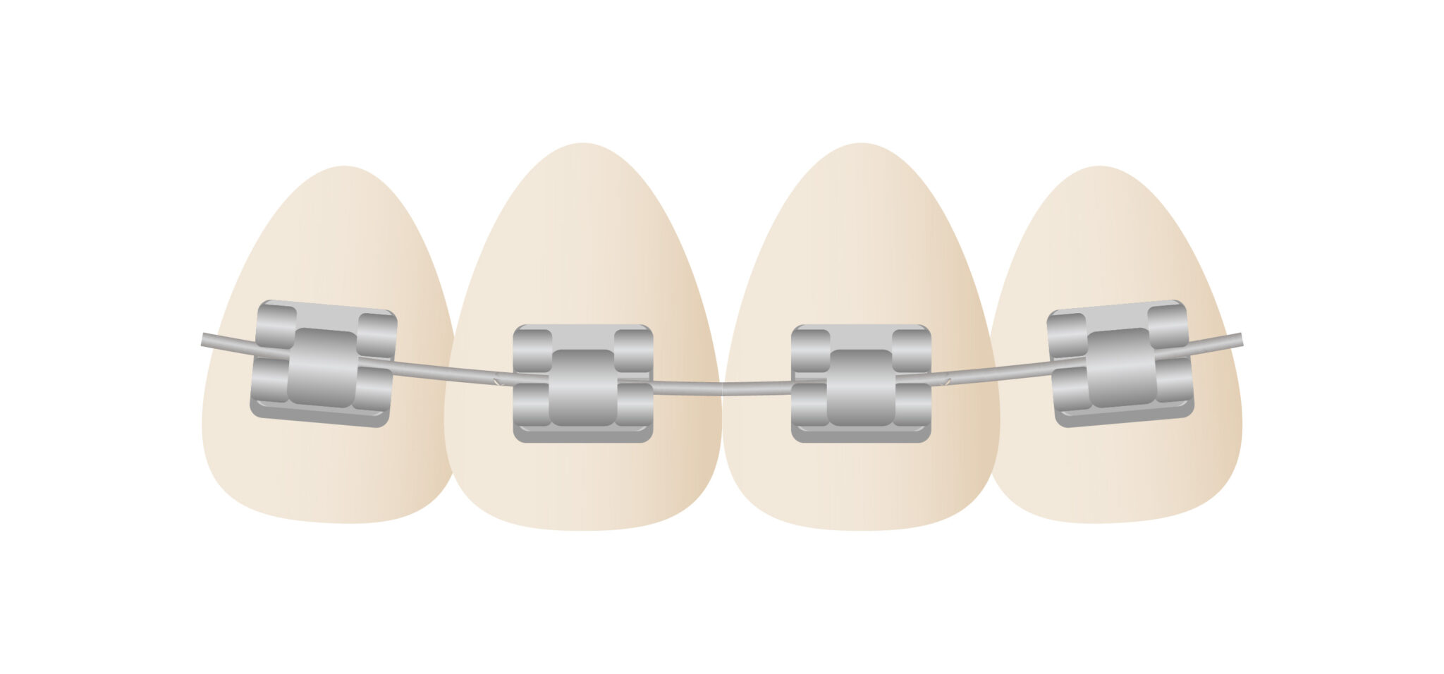 SelfLigating Braces in Taylorsville Hillstead Orthodontics